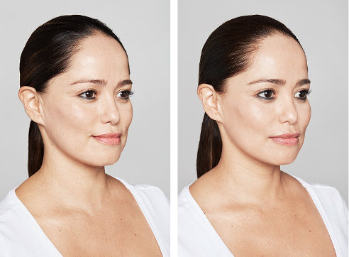Skinboosters 1 Rejuvenecimiento Facial con Restylane Vital (Skinboosters)