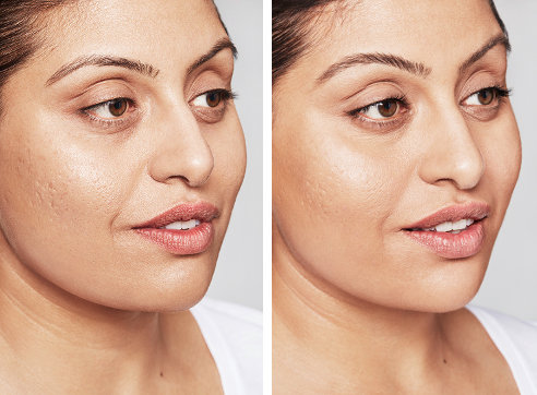 Skinboosters 2